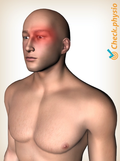 cabeza cefalea en racimos neuralgia de Horton ubicación del dolor