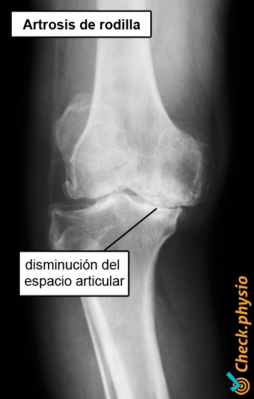 artrosis de rodilla radiografía