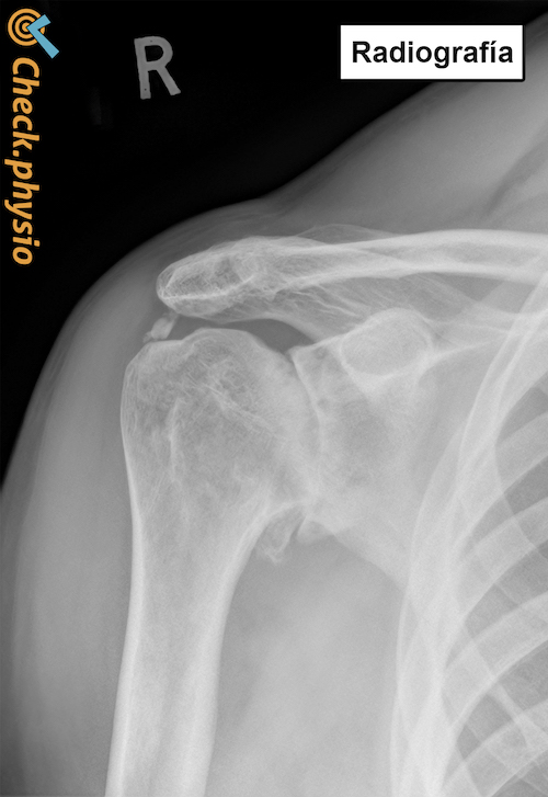 artrosis de hombro radiografía