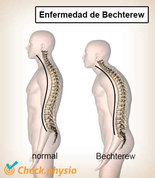 enfermedad de Bechterew cifosis espalda convexa